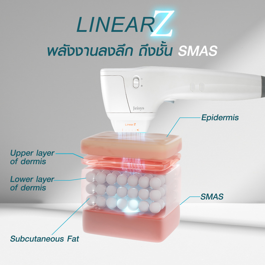 Linear Z, Linear Z คือ, ยกกระชับ, Hifu, ไฮฟู่, ยกกระชับหน้าเรียว, อยากหน้าเด็ก