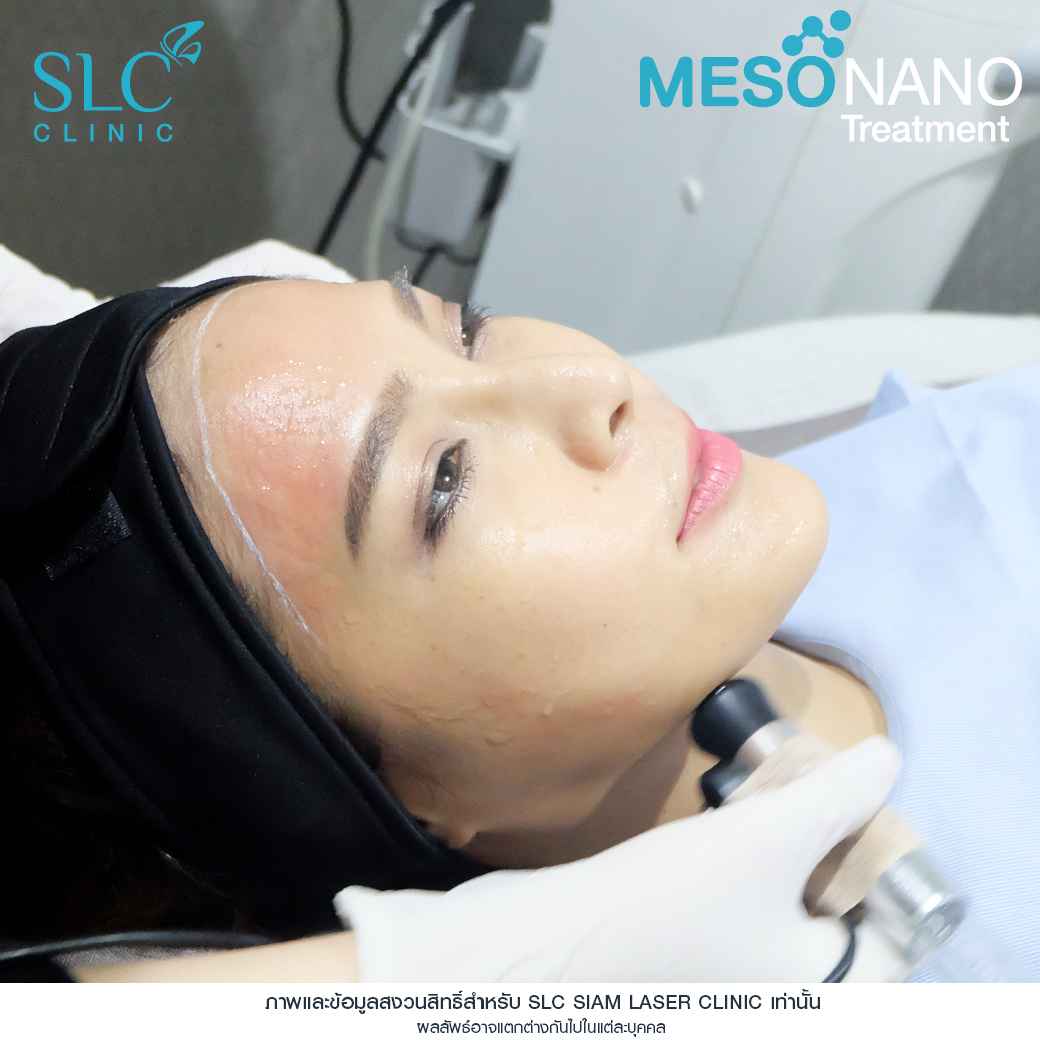 Meso Nano Treatment