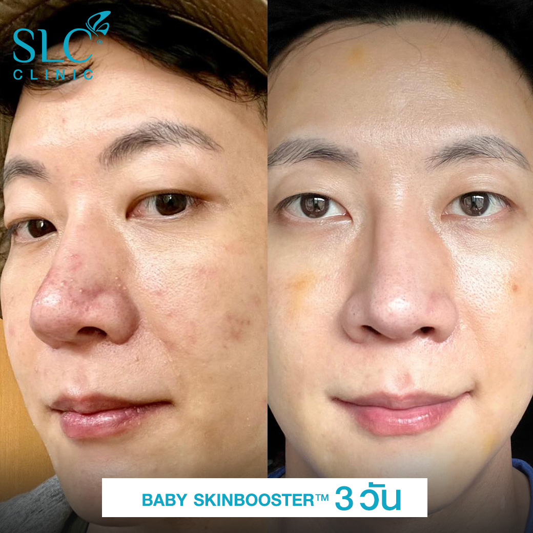 Exosome , Baby Skin Booster , วิตามินผิวเด็ก