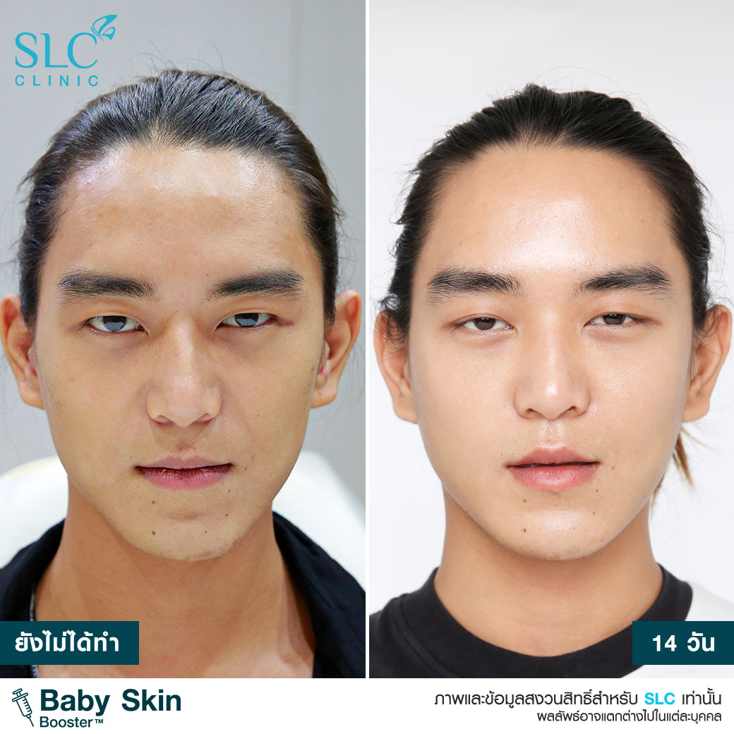 Exosome , Baby Skin Booster , วิตามินผิวเด็ก