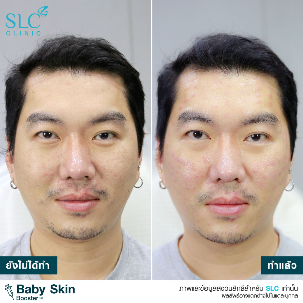 Exosome , Baby Skin Booster , วิตามินผิวเด็ก