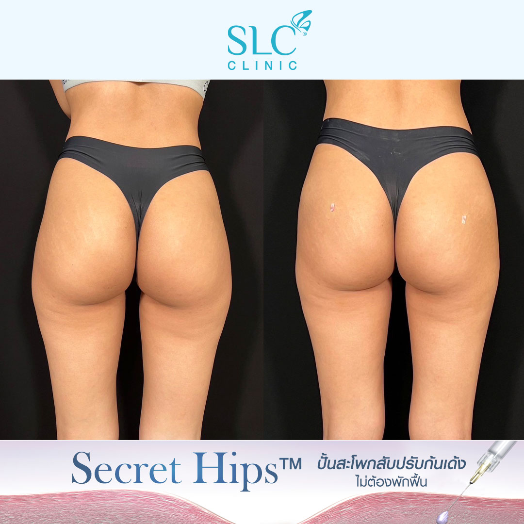 รีวิวเติมสะโพก , รีวิวเติมก้น , รีวิวเติมก้นบุ๋ม , รีวิวฉีดก้น , Variofill , Secret Hips