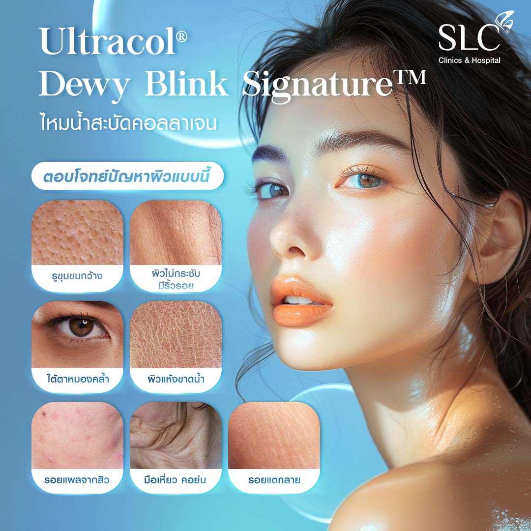 ไหมน้ำ, ไหมน้ำ SLC , SLC ไหมน้ำสะบัดคอลลาเจน, Ultracol 100 , ฉีดกระตุ้นคอลลาเจนผิว, Collagen Biostimulator, ไหมน้ำ คือ, ฉีดไหมน้ำ รีวิว, ultracol ใต้ตา