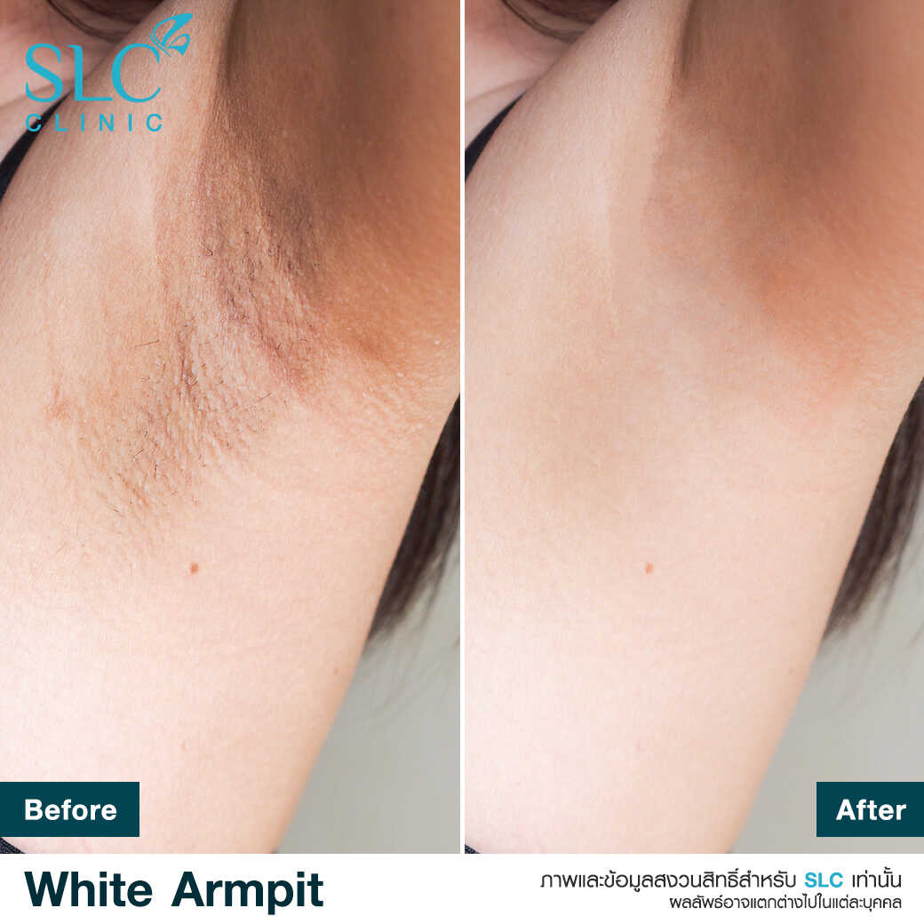 White Armpit Program