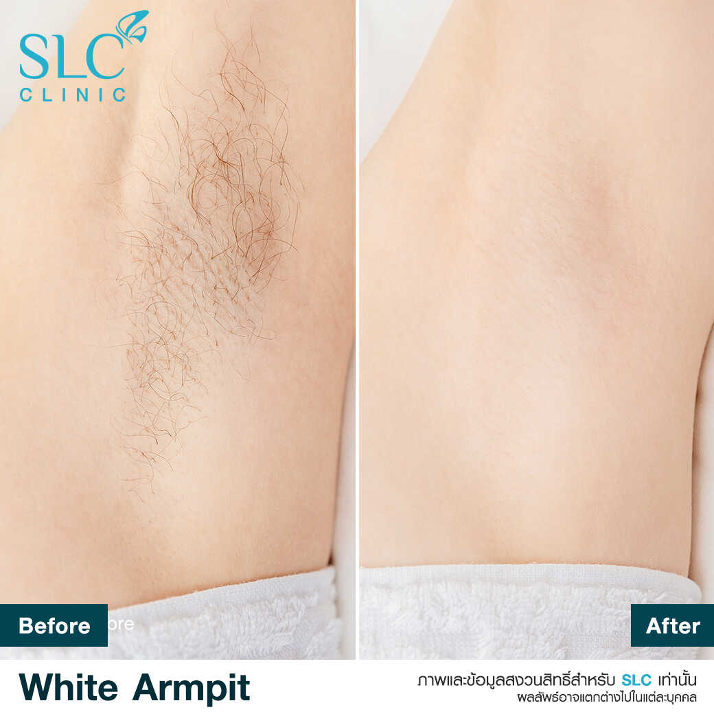 White Armpit Program