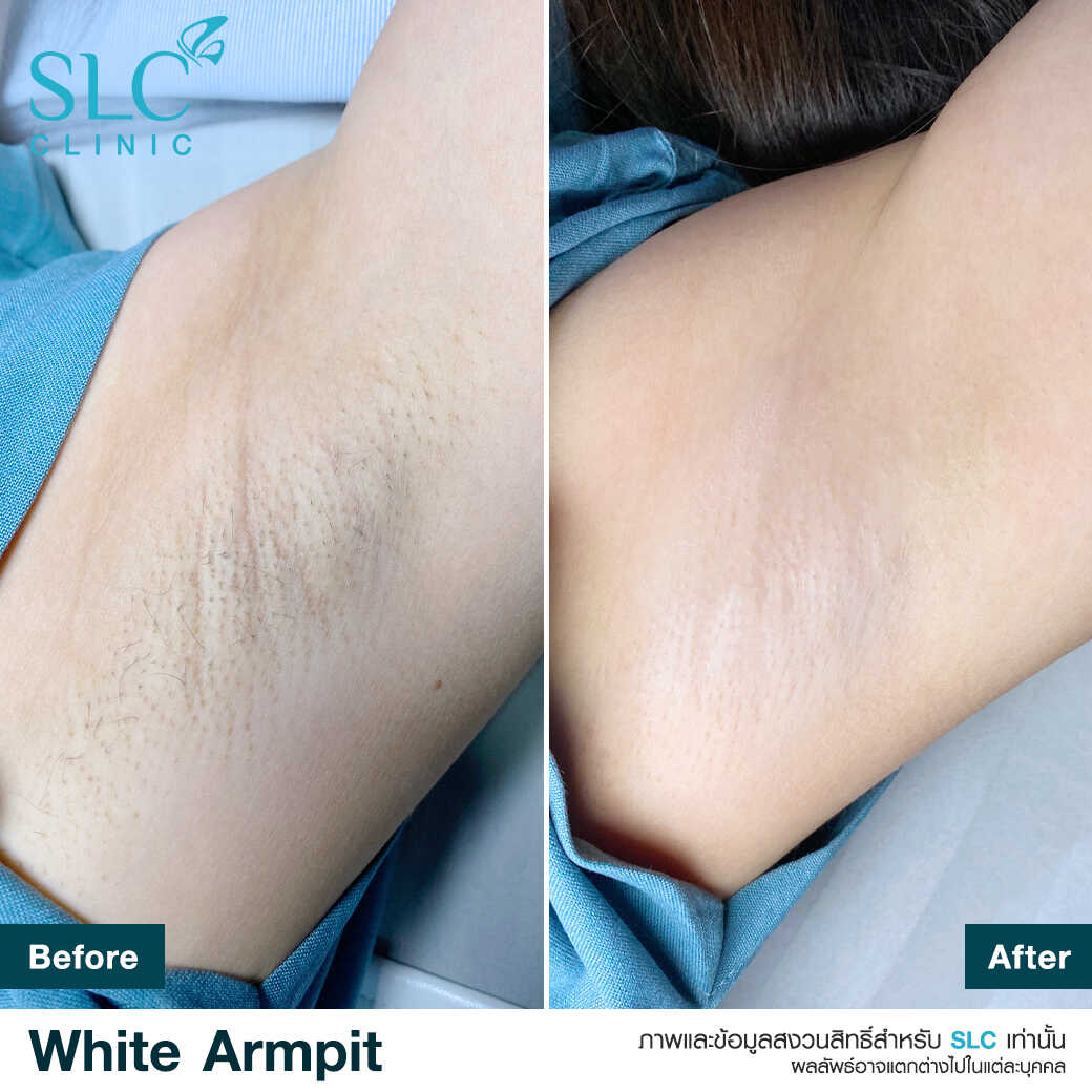 White Armpit Program