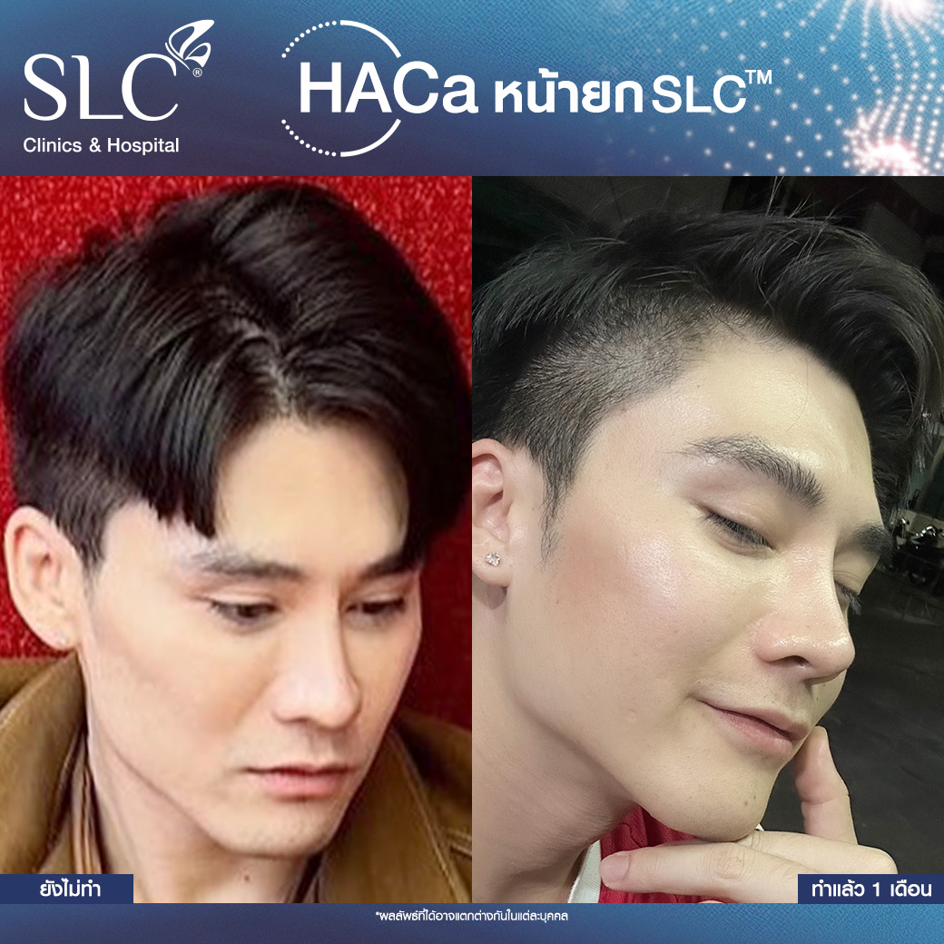 Hybrid Filler, HArmonyCa Filler, HArmonyCa ดีไหม, ผิวหลวม, ทำยังไงให้ผิวกระชับ, HaCa 