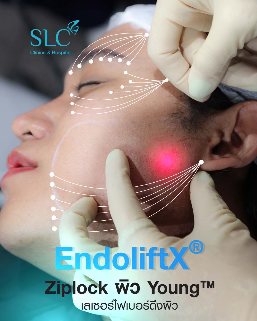 ยกกระชับด้วยเลเซอร์, ยกกระชับไร้แผล, EndoliftXSLC, endolift คืออะไร, EndoliftX