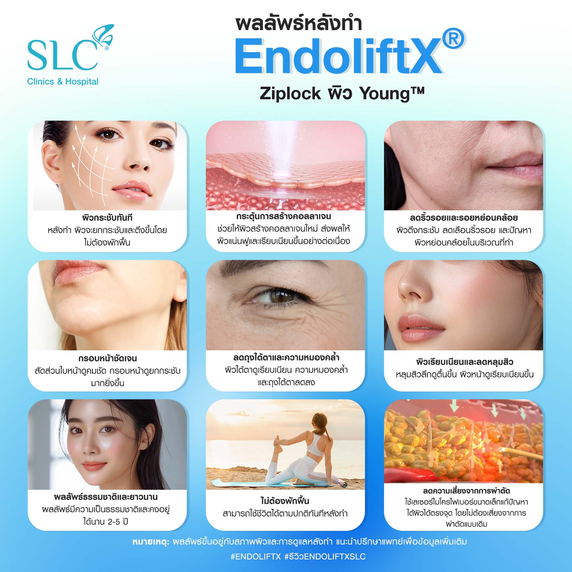 ยกกระชับด้วยเลเซอร์, ยกกระชับไร้แผล, EndoliftXSLC, endolift คืออะไร, EndoliftX