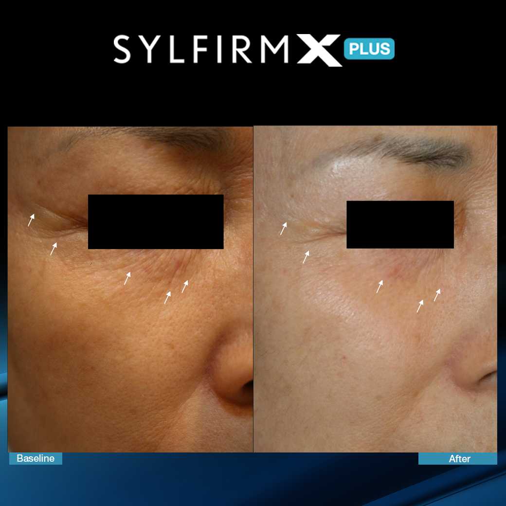 SylfirmXPlus