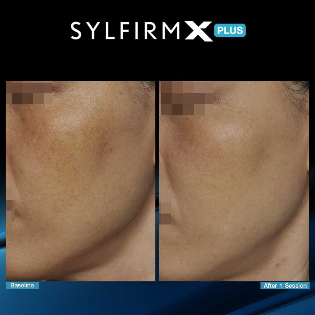 SylfirmXPlus