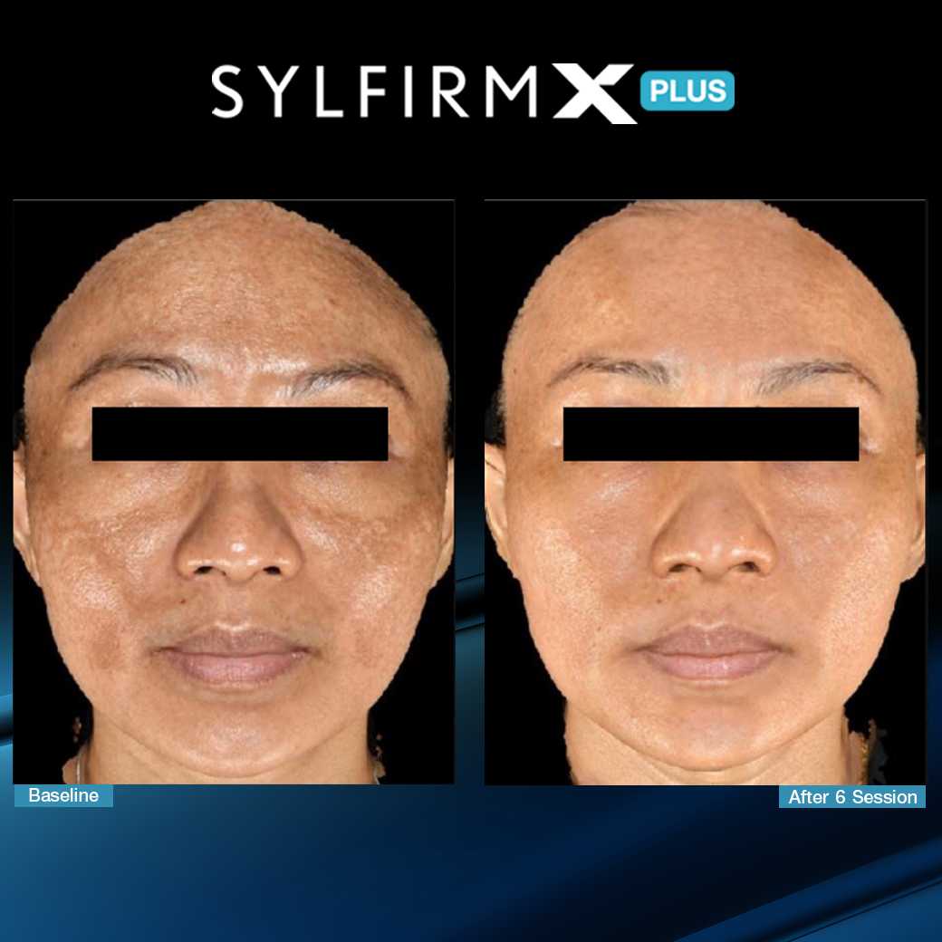 SylfirmXPlus